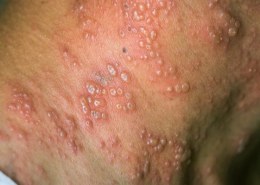 Is shingles contagious?