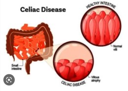 What is celiac disease?