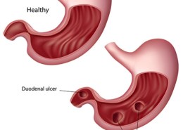 What is an ulcer?