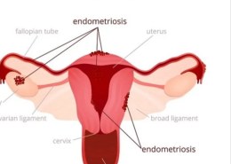 What is endometriosis?