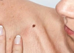 What does skin cancer look like?
