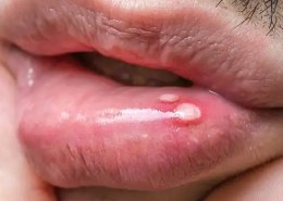 What does herpes look like?