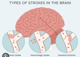 What is the main cause strokes?