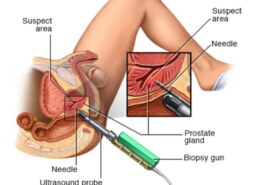 How can prostate gland cancer be treated, what causes it?